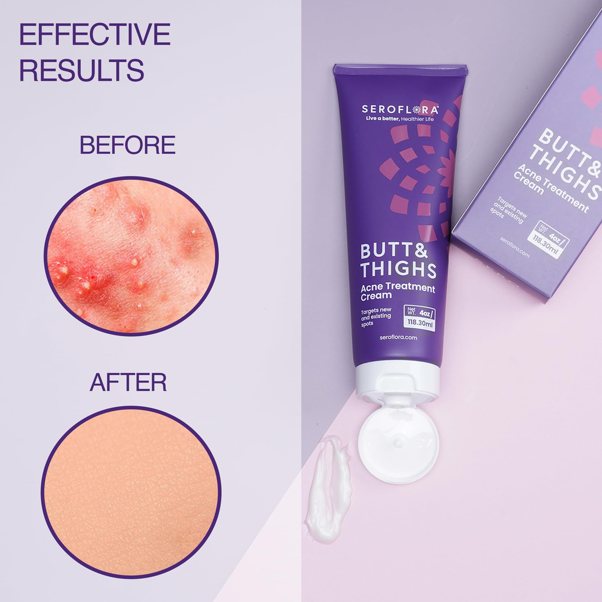 Creme De Tratamento Da Acne Seroflora Butt & Tighs 120ml - Imagem 4