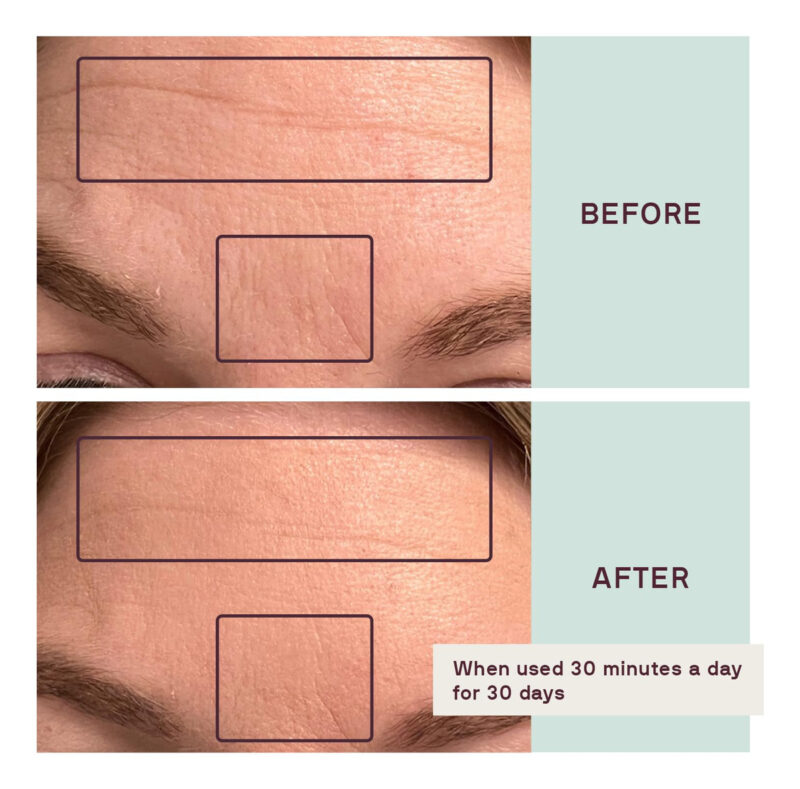 Kit De Adesivos Faciais Dermaclara Antirrugas Com Testa E Pe - Image 5