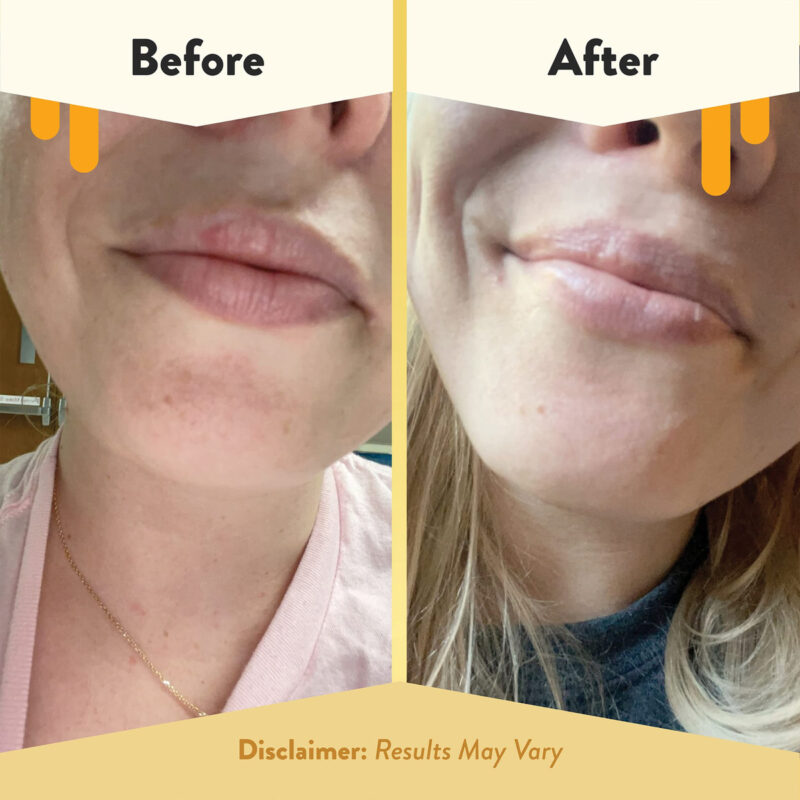 Bálsamo Labial Nutritivo Com Mel Para Eczema - Reparador Nat - Image 4