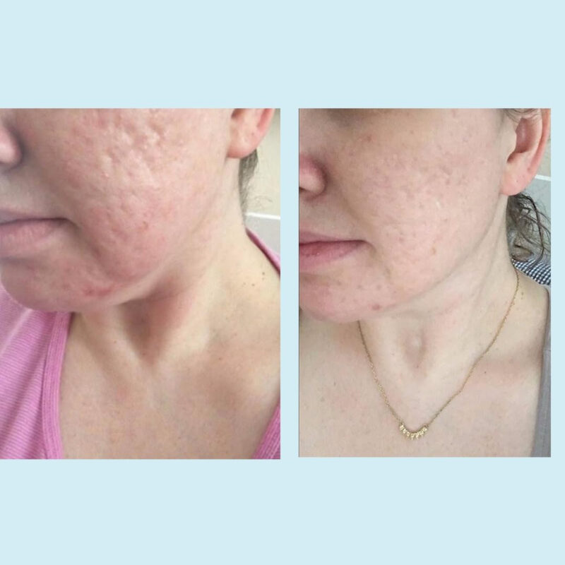 Ácido Glicólico Gel Peel Perfect Image 50% Com Retinol 30 Ml - Image 7