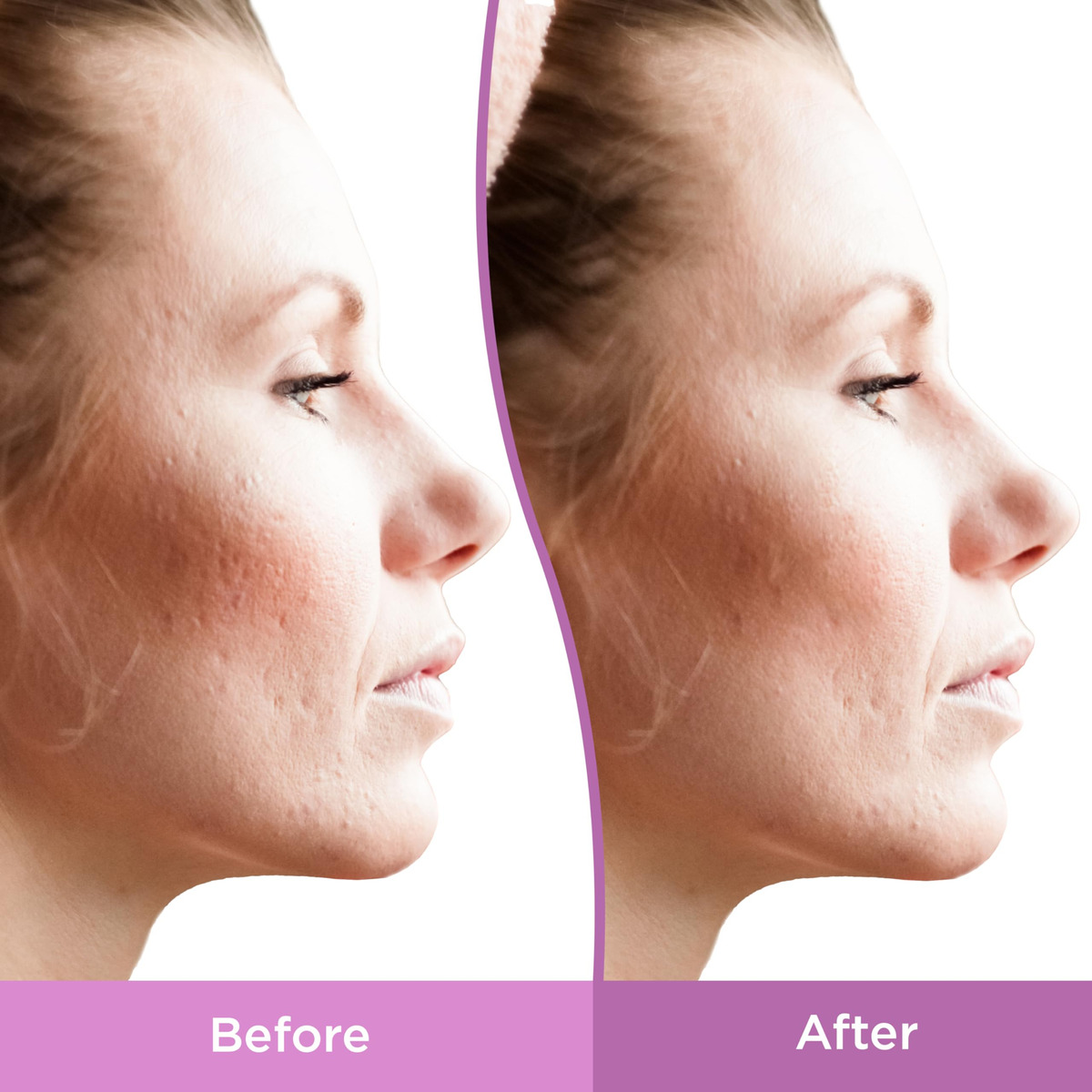 Gel De Tratamento Para Manchas De Cicatrizes De Acne Differi - Imagem 5
