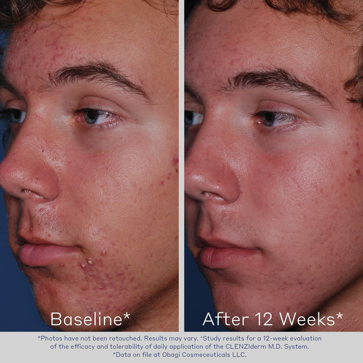 Limpador Espumante Para Acne Obagi Clenziderm M.d. Daily Car - Imagem 3
