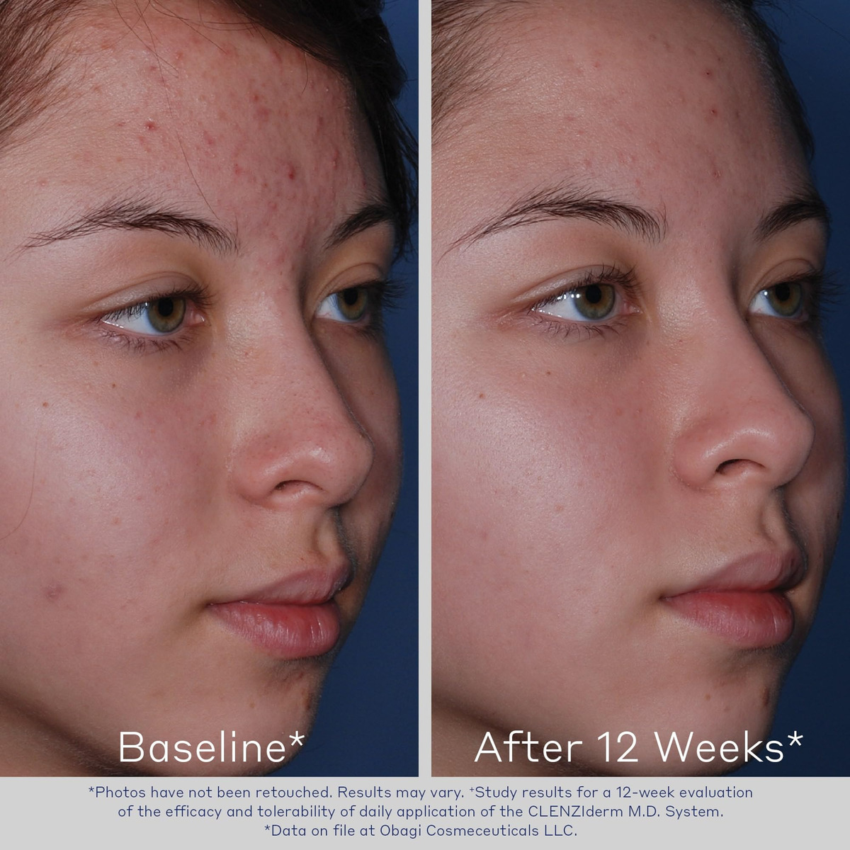 Limpador Espumante Para Acne Obagi Clenziderm M.d. Daily Car - Imagem 5