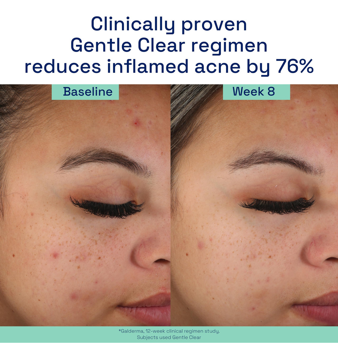 Hidratante Cetaphil Gentle Clear Matifying Acne 90ml - Imagem 7