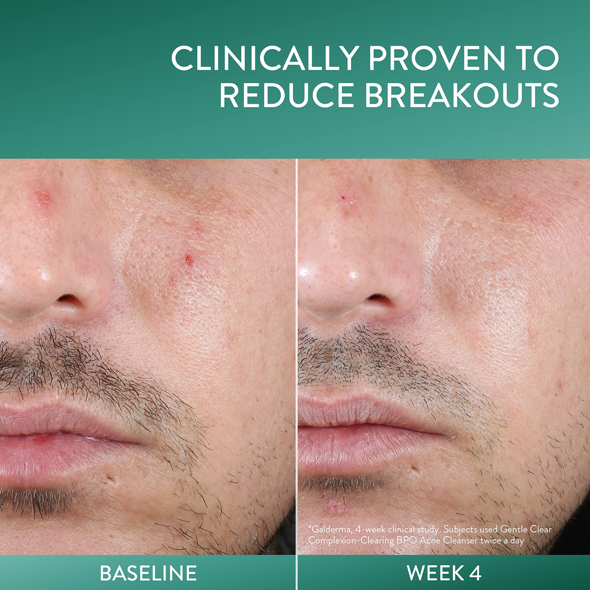 Cetaphil Gentle Clear Complexionclearing Bpo Acne - Imagem 6
