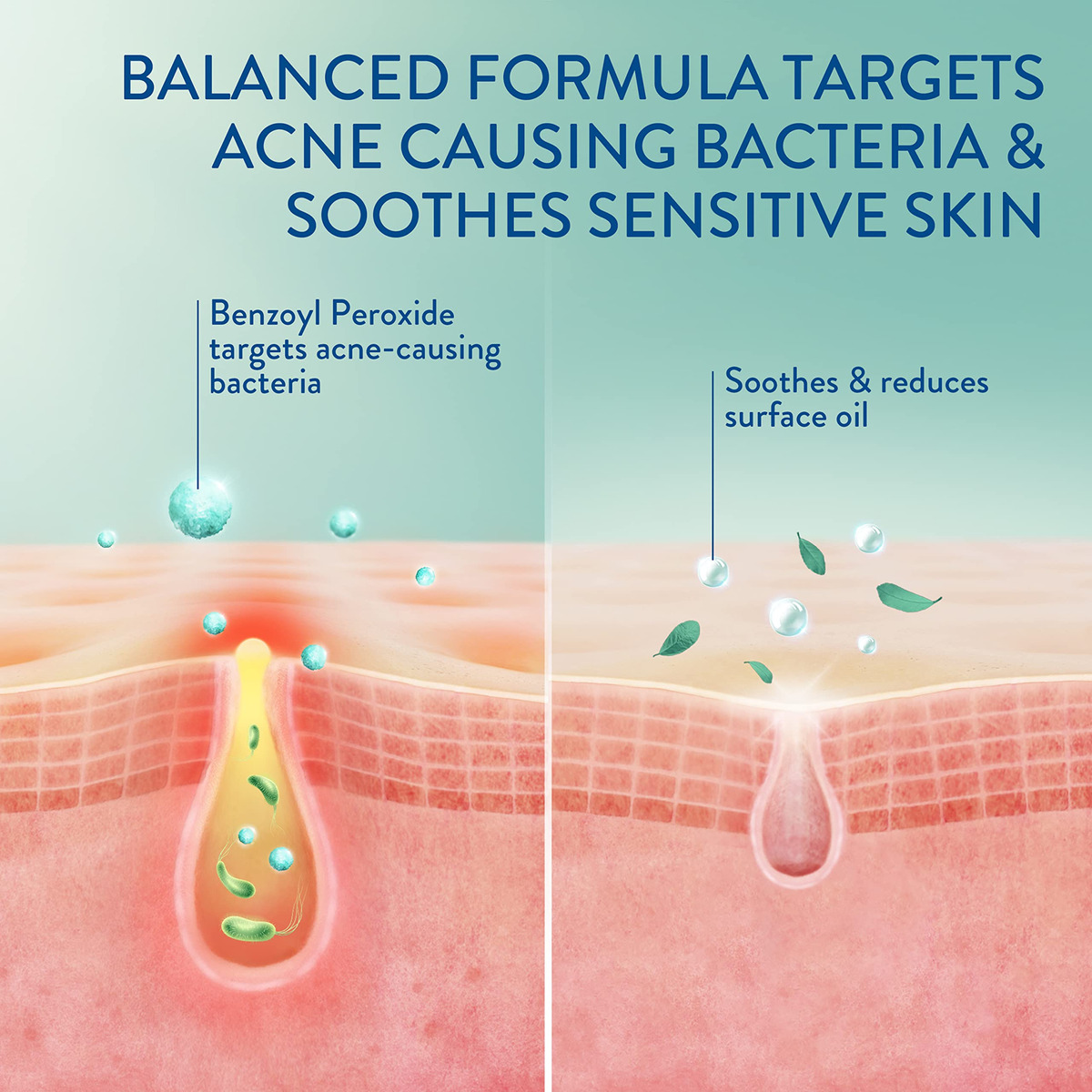 Cetaphil Gentle Clear Complexionclearing Bpo Acne - Imagem 8