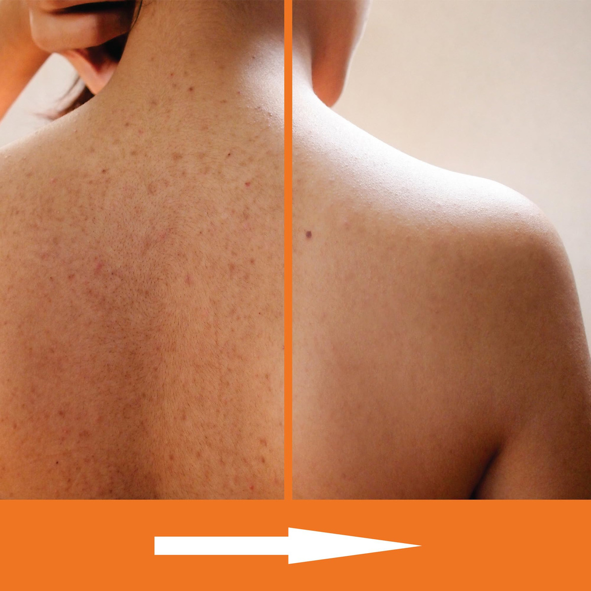 Sabonete Líquido Esfoliante Kerapil Com Ácido Salicílico 480 - Imagem 3