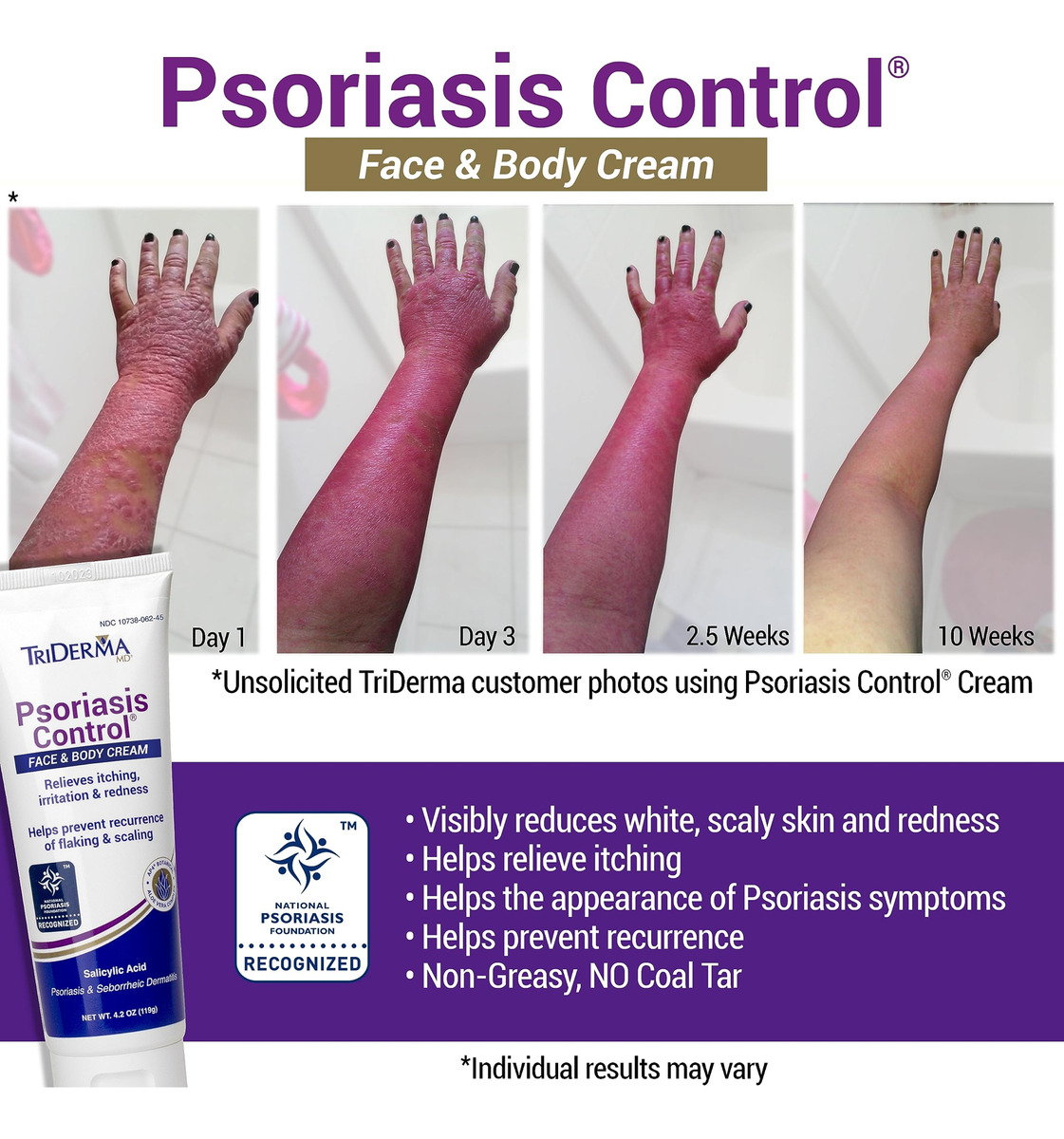 Creme Triderma Para Controle De Psoríase Para Rosto E Corpo - Imagem 2