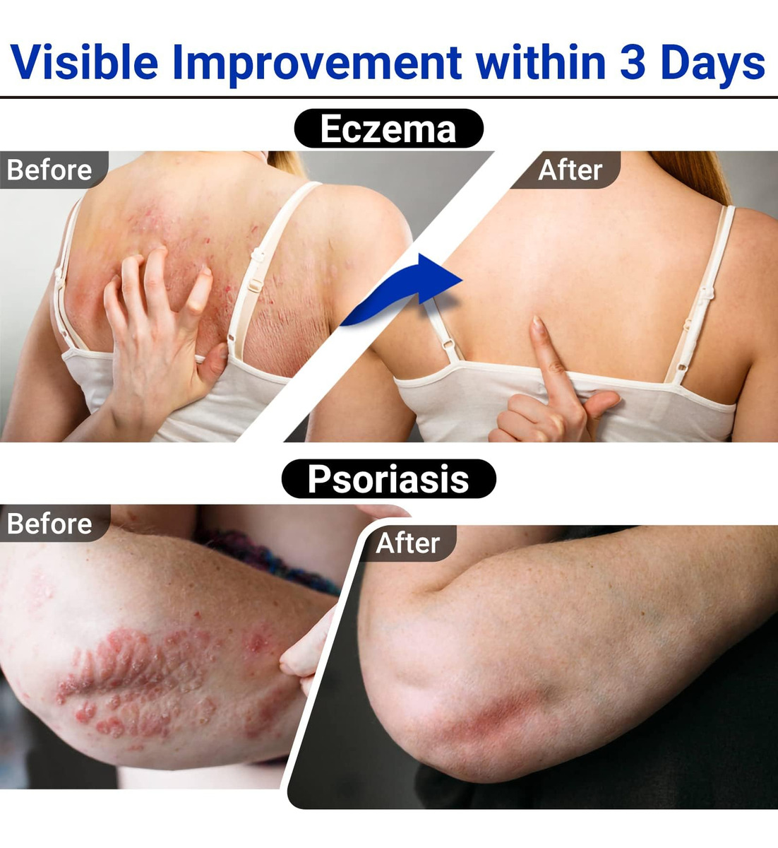 Creme Para Eczema Lmnoop Maximum Strength Treatment Pomada - Imagem 4