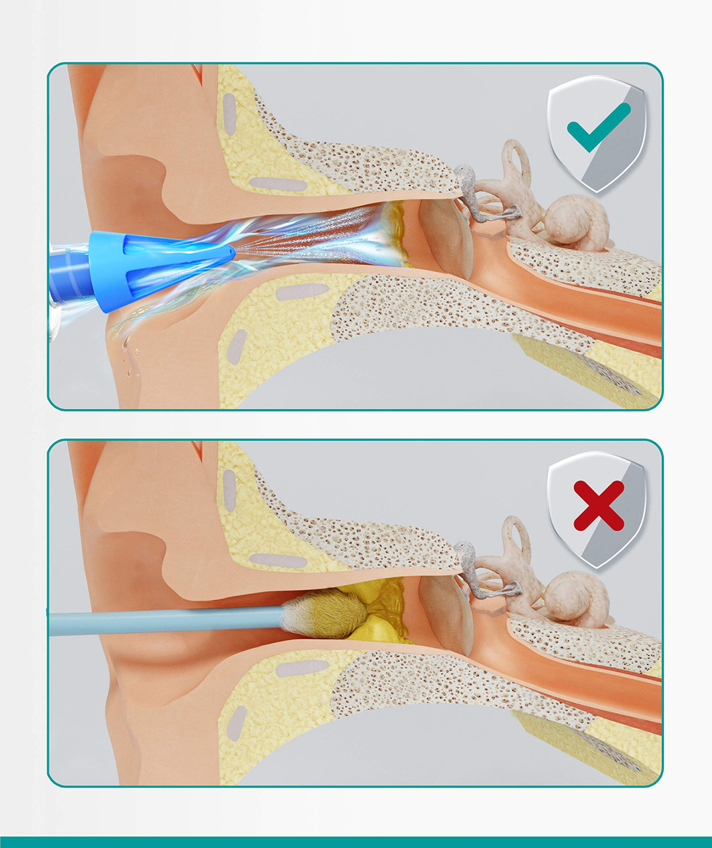 Seringa De Remoção De Cera De Ouvido Medi Grade Natural Clea - Imagem 5