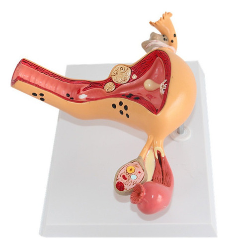 Modelo Anatômico De Ovário E Útero Com Patologias - Imagem 7