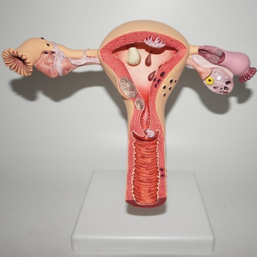 Modelo Anatômico De Ovário E Útero Com Patologias - Imagem 2