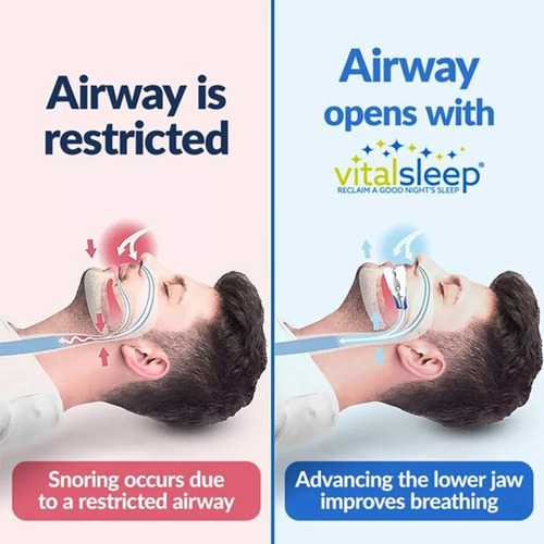 Adjustable Mouth Guard With Anti-snoring Device. - Imagem 8