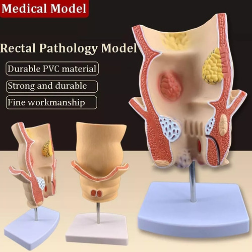 Modelo Retal Patológico Humano, Modelo De Reto Com Lesão De - Imagem 2