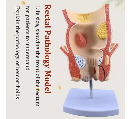 Modelo Retal Patológico Humano, Modelo De Reto Com Lesão De - Imagem 4