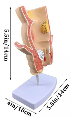 Modelo Retal Patológico Humano, Modelo De Reto Com Lesão De - Imagem 3