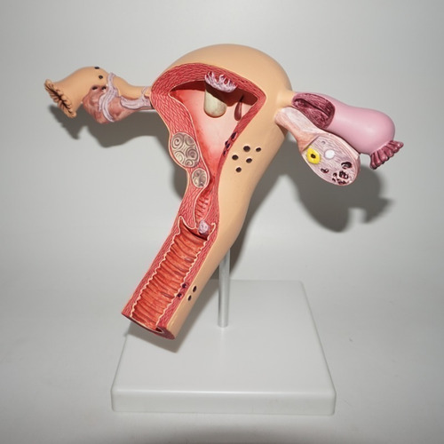 Modelo Anatômico De Ovário E Útero Com Patologias - Imagem 5