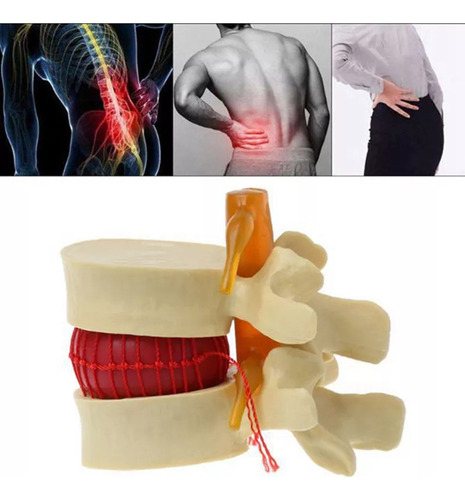Modelo De Vértebra Lombar: Disco Herniado Anatômico Da Colun - Imagem 5