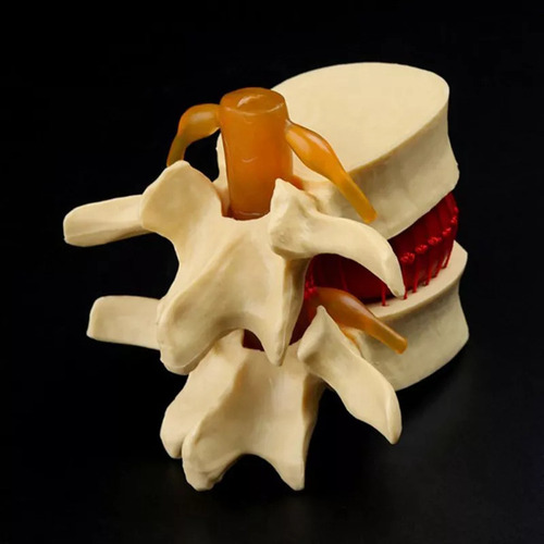 Modelo De Vértebra Lombar: Disco Herniado Anatômico Da Colun - Imagem 6
