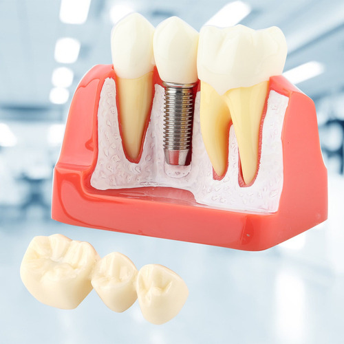 Análise De Implante De Modelo Dentário De Demonstração Dentá - Imagem 4
