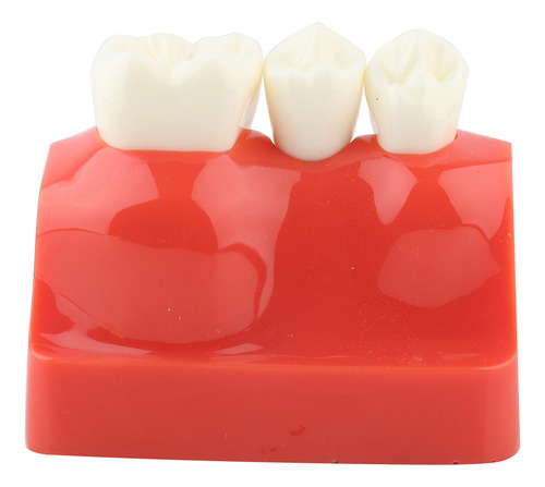Análise De Implante De Modelo Dentário De Demonstração Dentá - Imagem 3