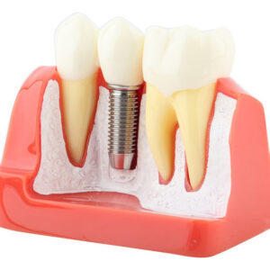 Análise De Implante De Modelo Dentário De Demonstração Dentá