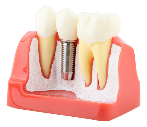 Análise De Implante De Modelo Dentário De Demonstração Dentá