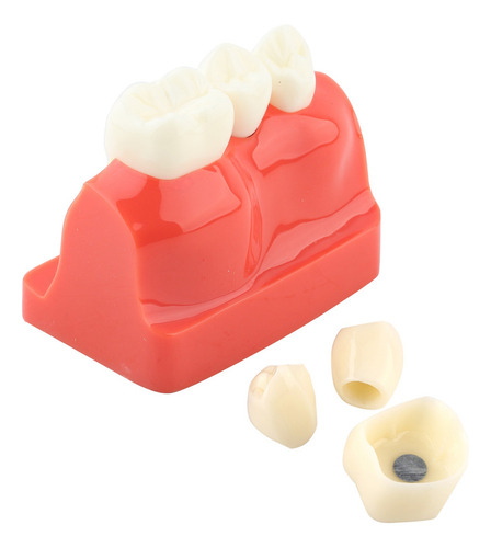 Análise De Implante De Modelo Dentário De Demonstração Dentá - Imagem 9