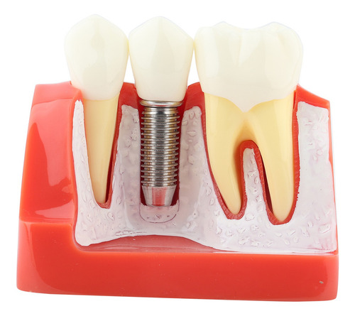 Análise De Implante De Modelo Dentário De Demonstração Dentá - Imagem 2