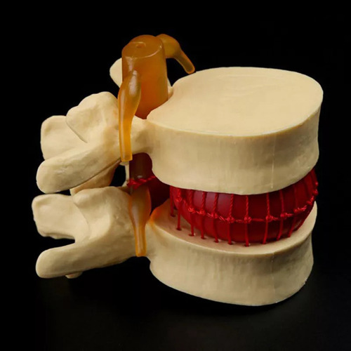 Modelo De Vértebra Lombar: Disco Herniado Anatômico Da Colun - Imagem 3