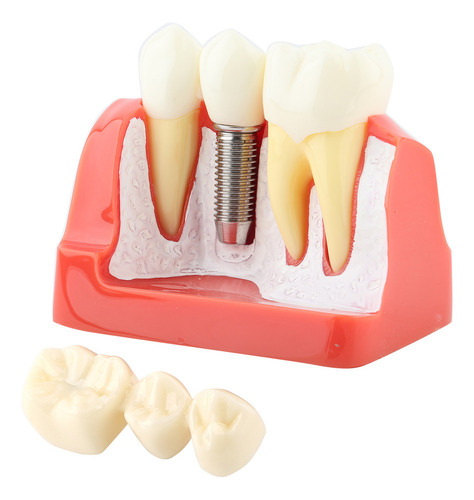 Análise De Implante De Modelo Dentário De Demonstração Dentá - Imagem 6