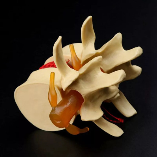 Modelo De Vértebra Lombar: Disco Herniado Anatômico Da Colun - Imagem 2