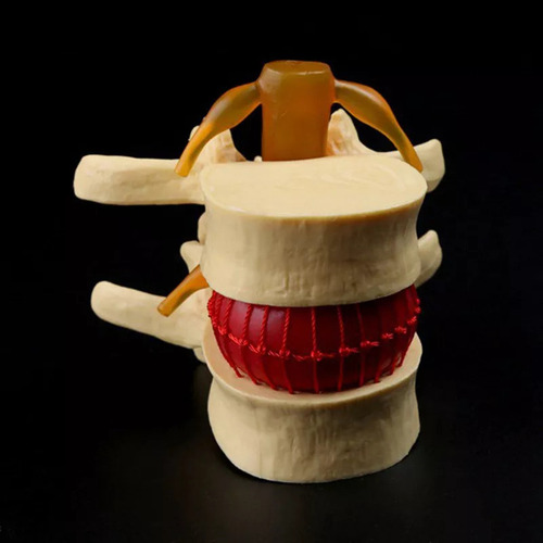 Modelo De Vértebra Lombar: Disco Herniado Anatômico Da Colun - Imagem 8