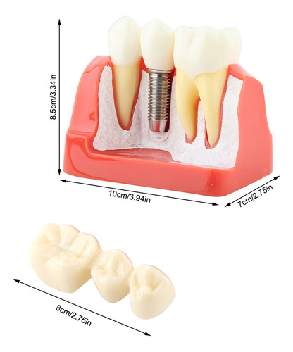 Análise De Implante De Modelo Dentário De Demonstração Dentá - Imagem 10