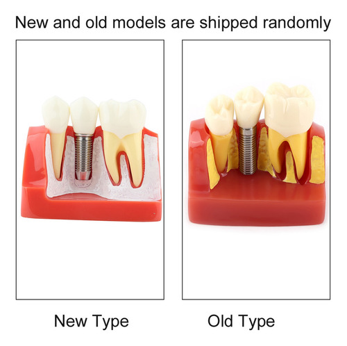 Análise De Implante De Modelo Dentário De Demonstração Dentá - Imagem 7