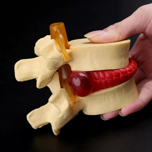 Modelo De Vértebra Lombar: Disco Herniado Anatômico Da Colun - Imagem 4