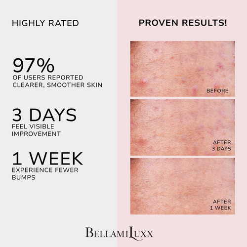 Creme Corporal Para Tratamento De Acne Bellamiluxx - Imagem 2