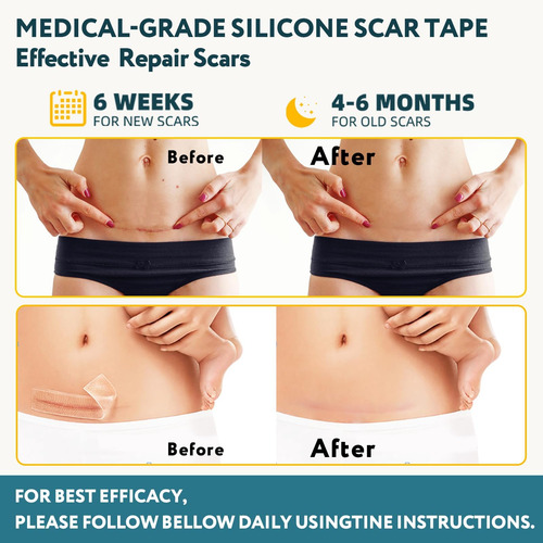 Folhas De Silicone Para Cicatrizes 60 Fitas Para Cicatrizes - Imagem 3